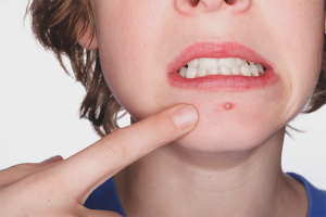 How to get rid of subcutaneous acne on the chin