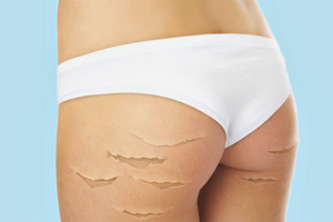 How to get rid of stretch marks on the legs