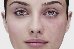 How to remove capillaries on the face